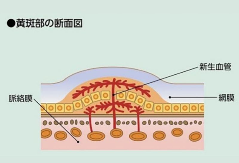 加齢性黄斑変性症とは