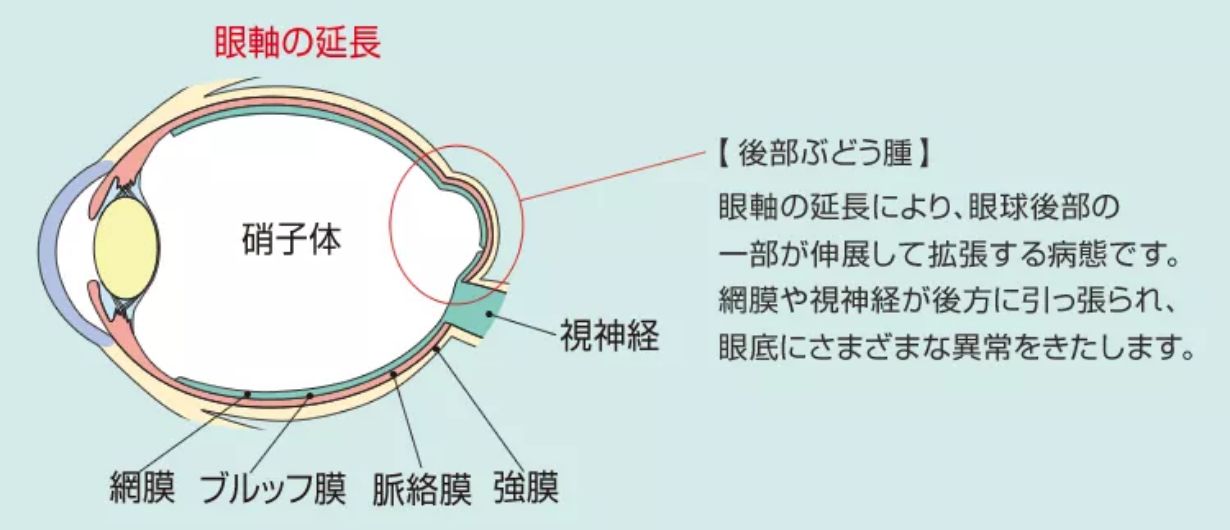 近視性脈絡膜新生血管(脈絡膜新生血管)とは